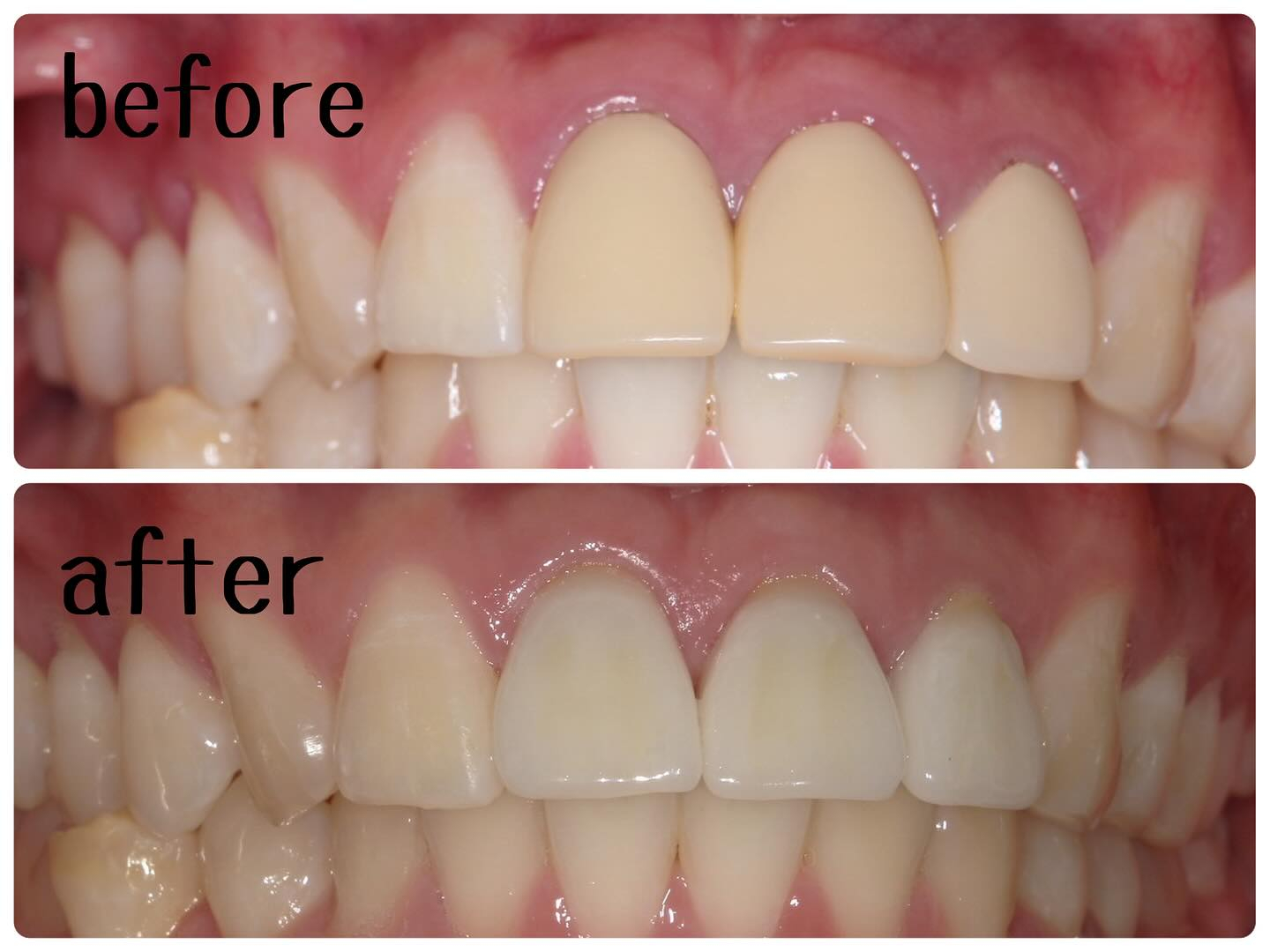 症例写真〜前歯の被せ物(自由診療)〜