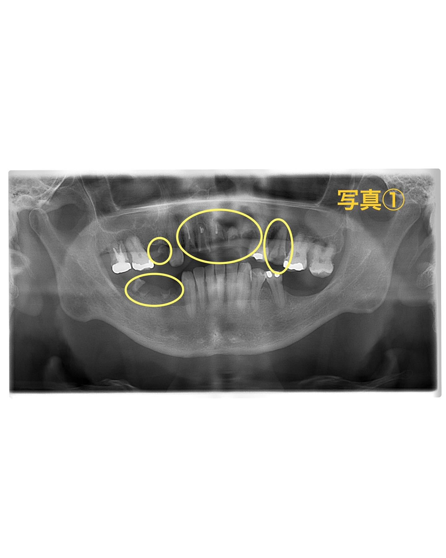 症例写真〜多数歯抜歯が必要なケース〜