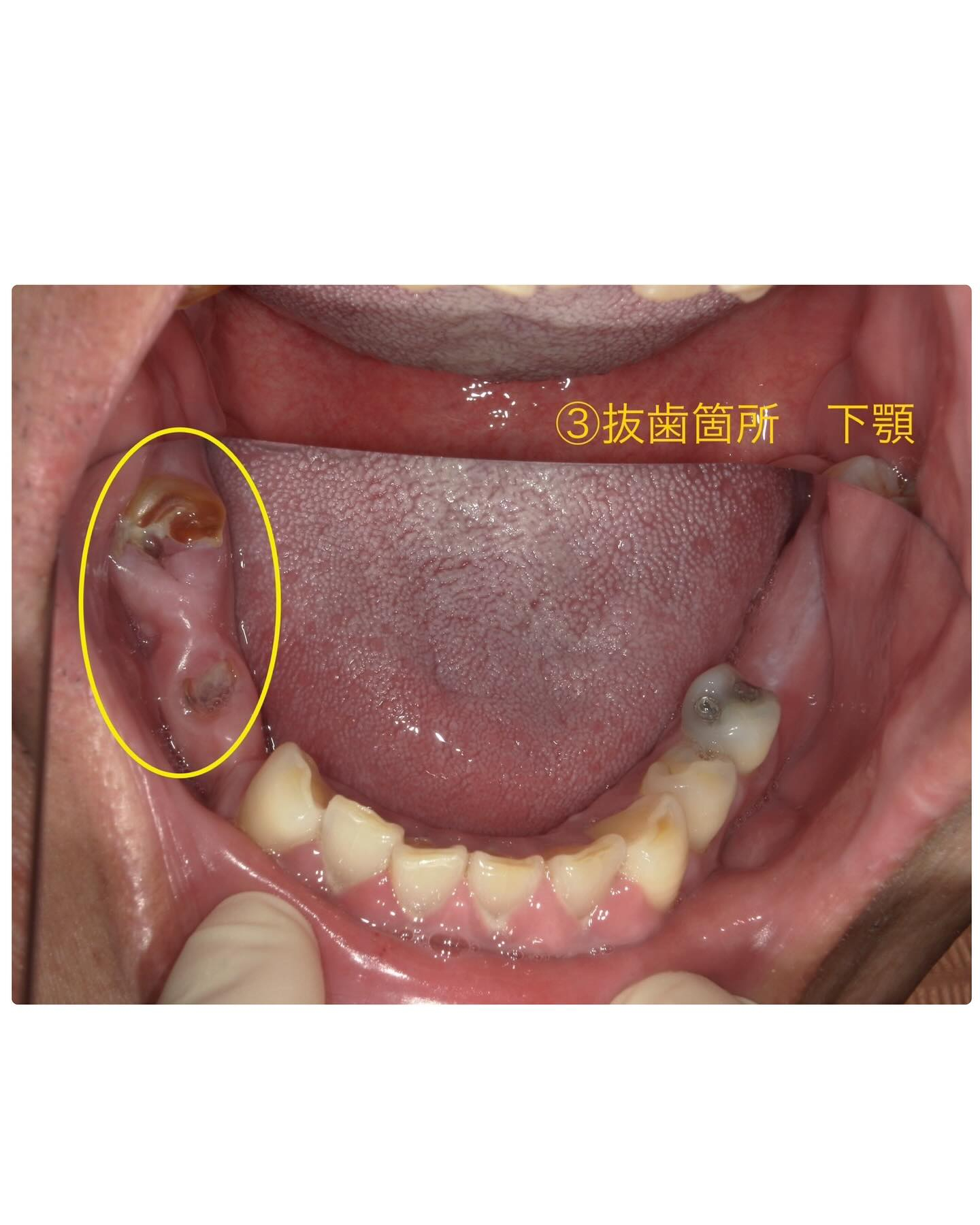 症例写真〜多数歯抜歯が必要なケース〜