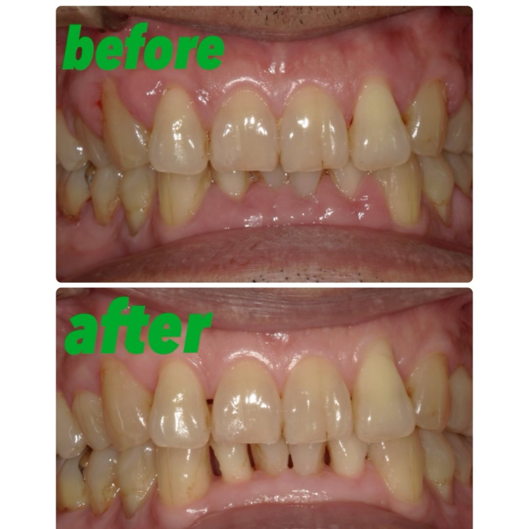 板橋区で実施している成人歯科検診を機に来院された患者さんです...