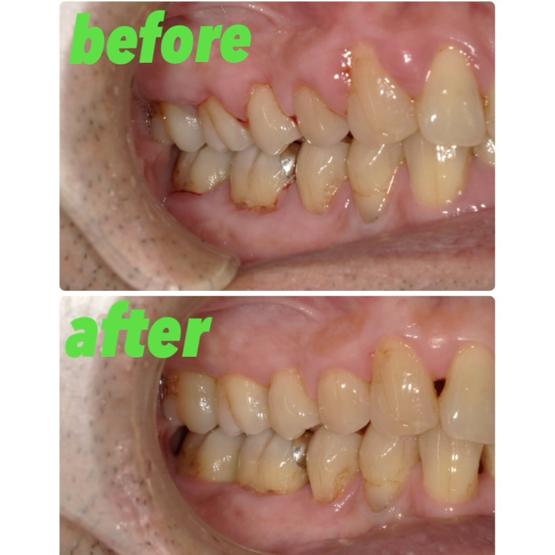 板橋区で実施している成人歯科検診を機に来院された患者さんです...