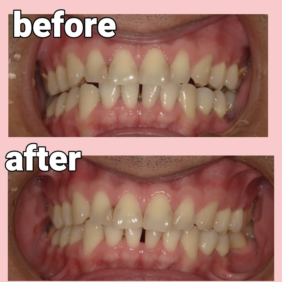 歯石と虫歯を主訴に来院した患者さんです🦷