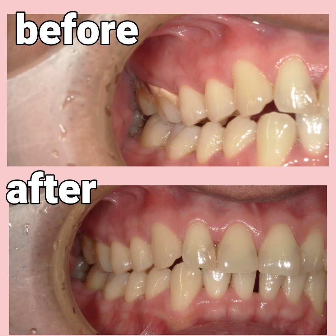 歯石と虫歯を主訴に来院した患者さんです🦷