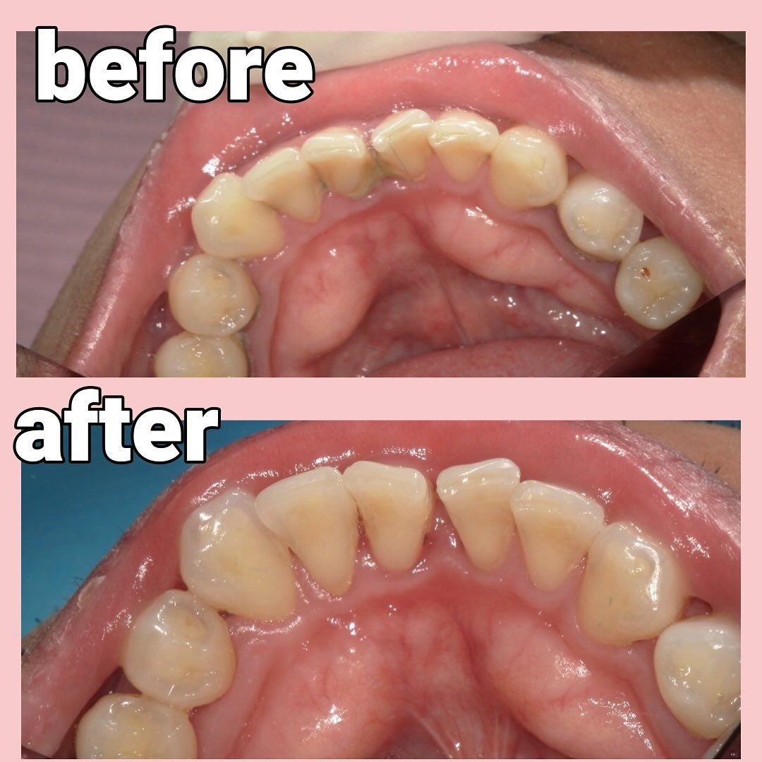 歯石と虫歯を主訴に来院した患者さんです🦷