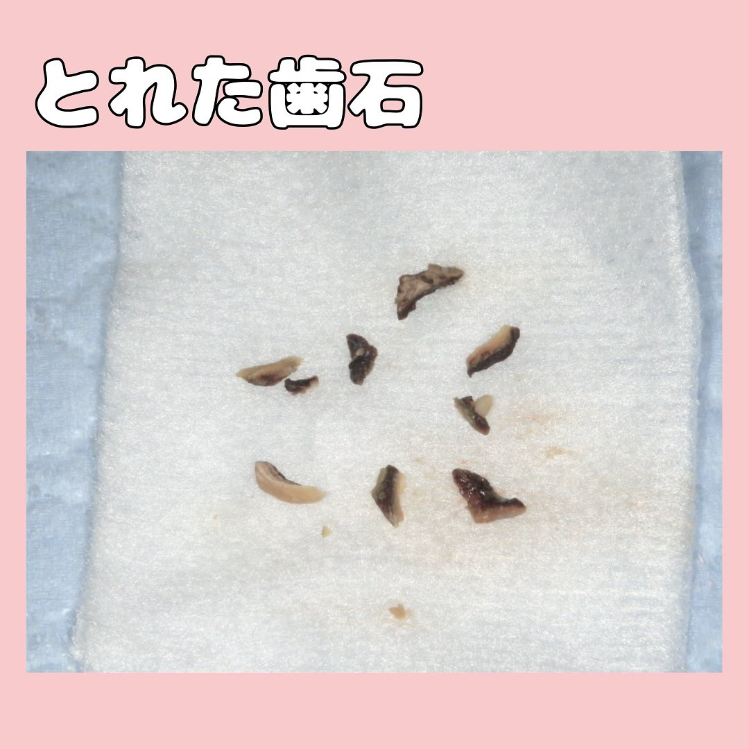 歯石と虫歯を主訴に来院した患者さんです🦷