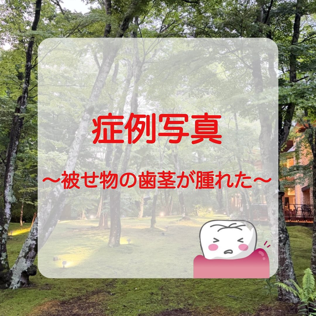 右下の被せ物の歯茎が腫れたと来院された患者さんの症例写真をお...