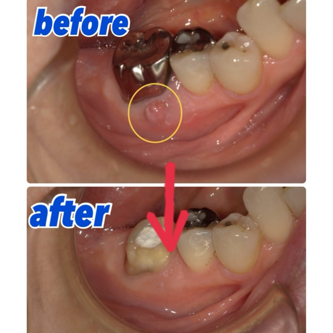 右下の被せ物の歯茎が腫れたと来院された患者さんの症例写真をお...