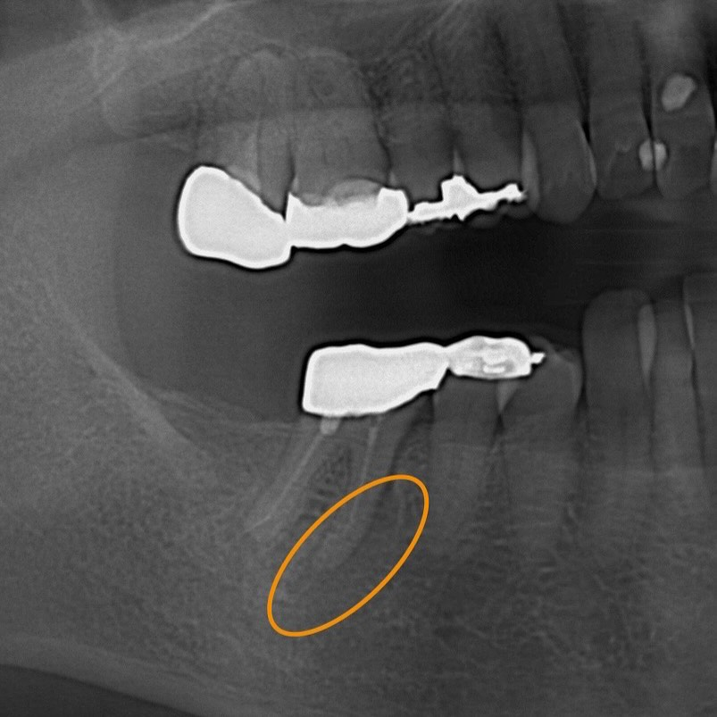 右下の被せ物の歯茎が腫れたと来院された患者さんの症例写真をお...