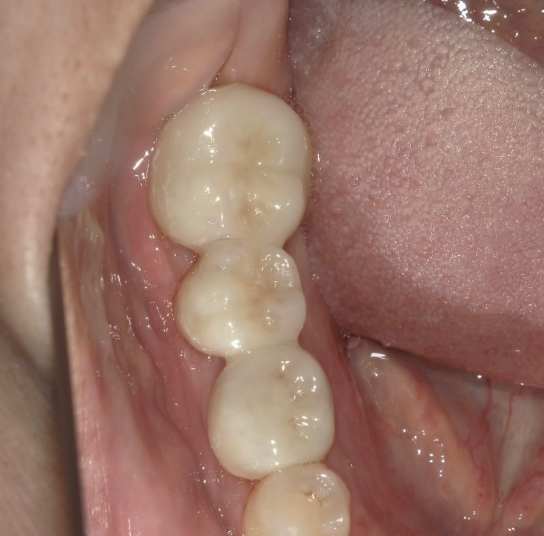 今回紹介する症例は、いつもの保険診療の内容ではなく自由診療の...