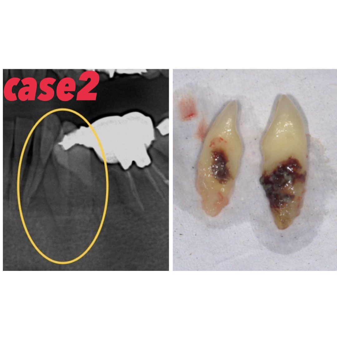今日は歯石のお話です🔥