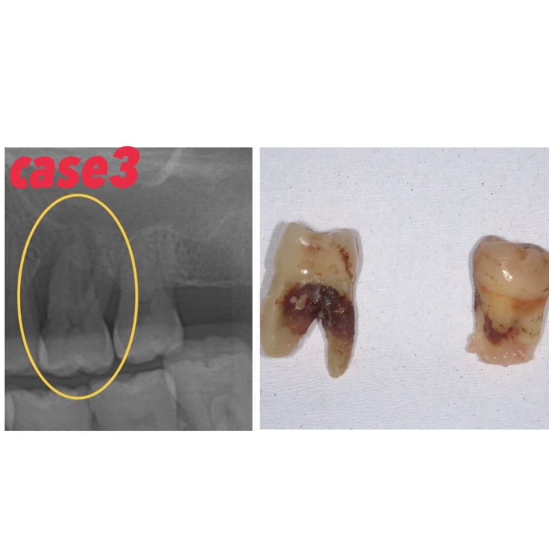 今日は歯石のお話です🔥