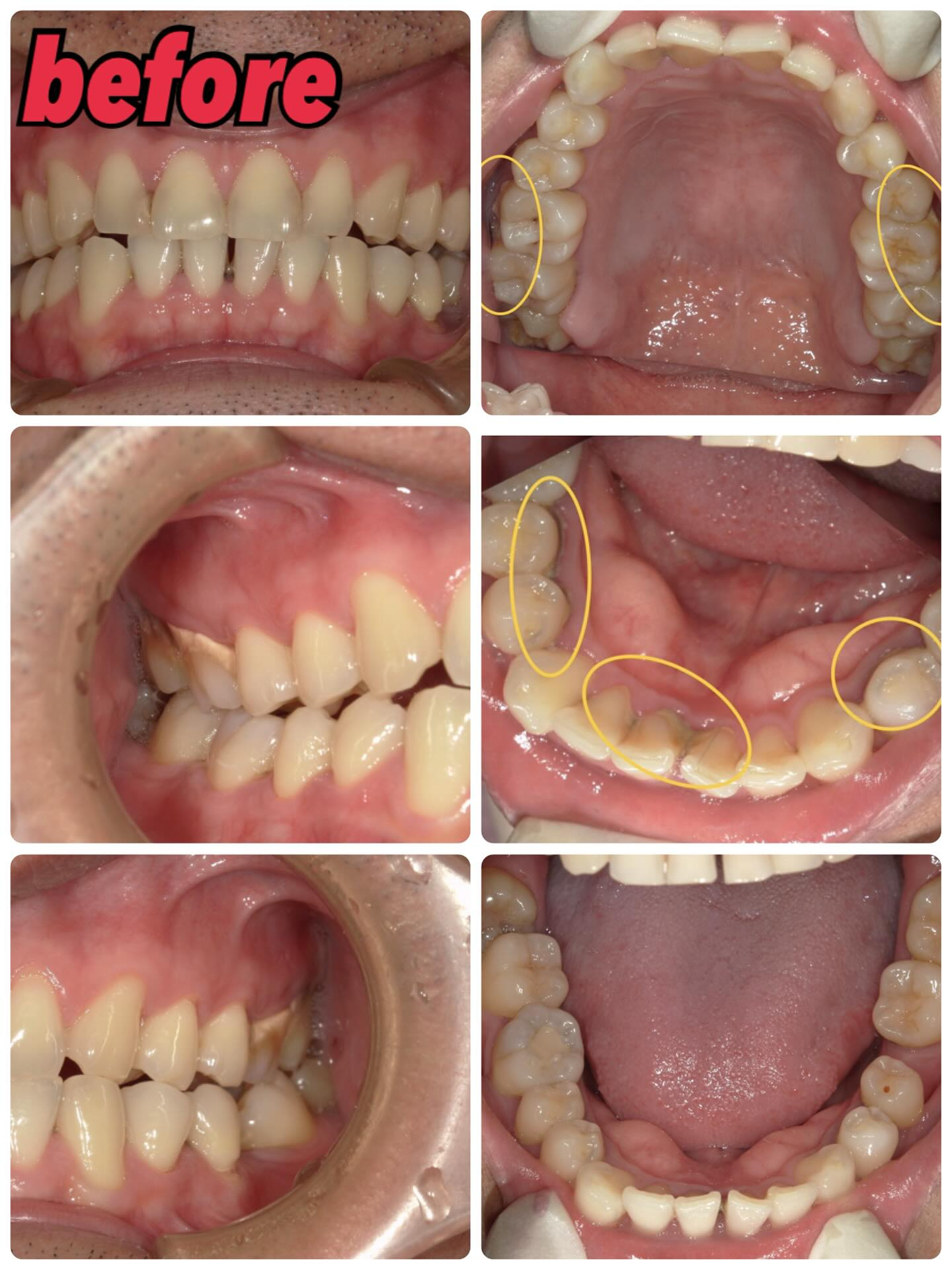歯石除去前、除去後、除去した歯石の写真です📸☝️