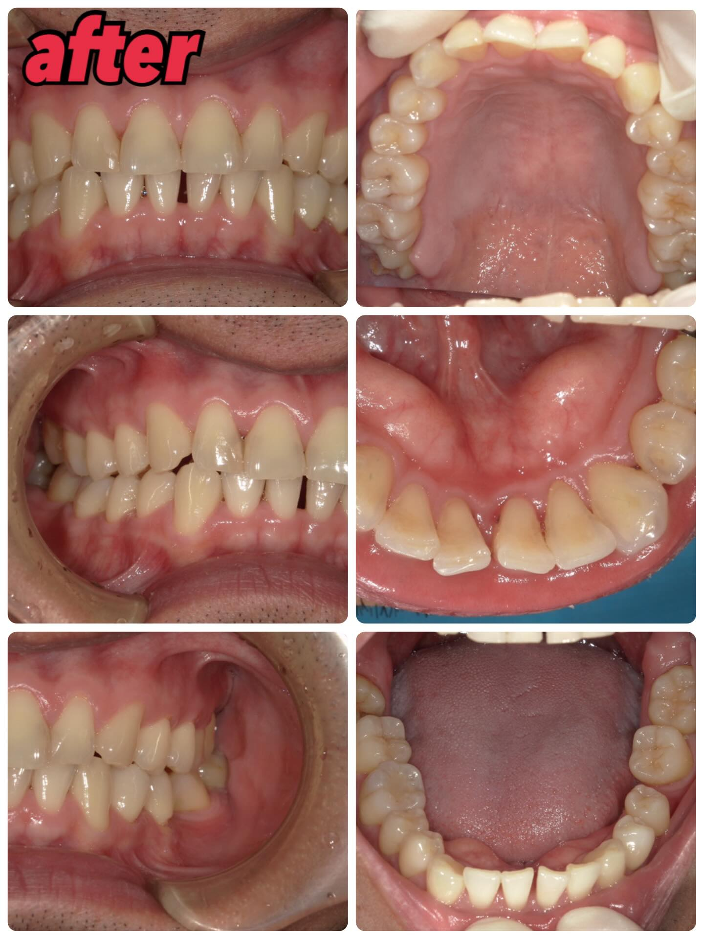 歯石除去前、除去後、除去した歯石の写真です📸☝️
