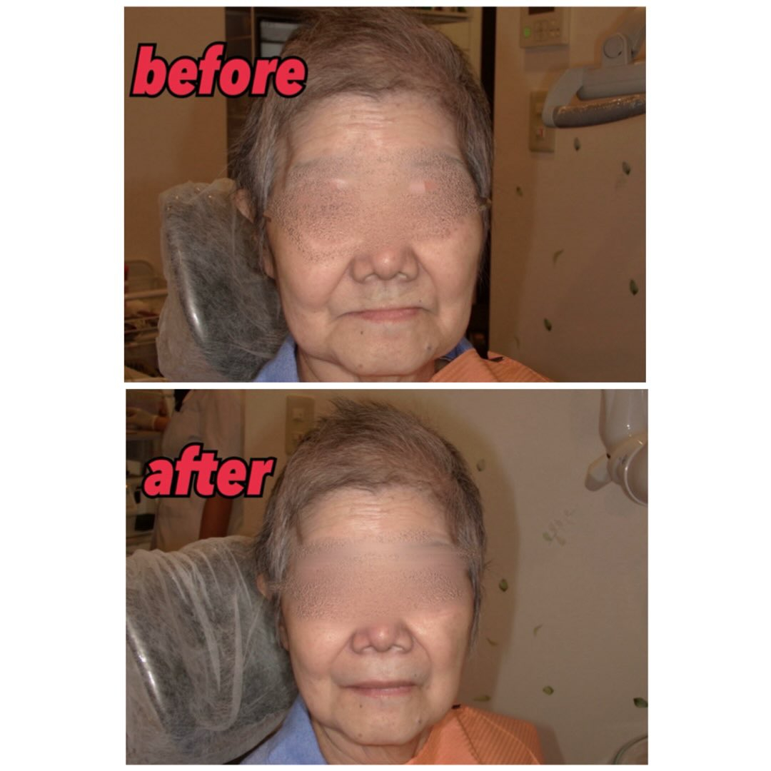 入れ歯による顔貌変化について