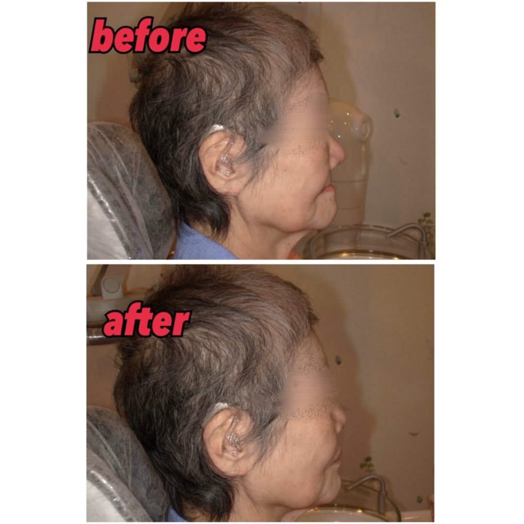 入れ歯による顔貌変化について