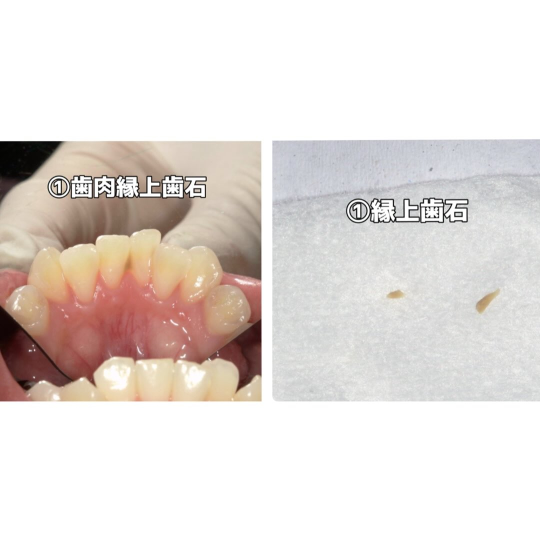 以前歯石のお話をしましたが、今回もその続きになります☝️