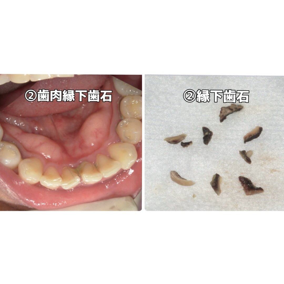 以前歯石のお話をしましたが、今回もその続きになります☝️