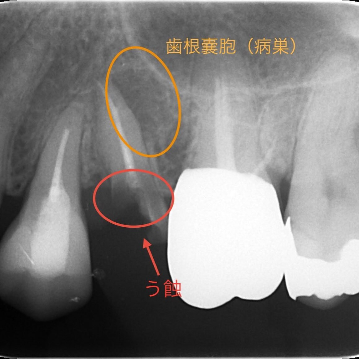 骨支持が不足している事により抜歯に至ったケースを紹介します🦷