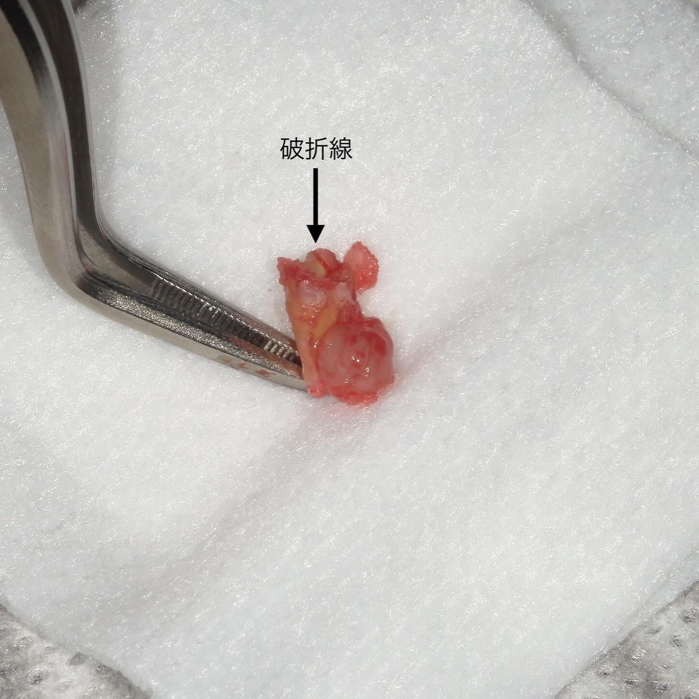 骨支持が不足している事により抜歯に至ったケースを紹介します🦷