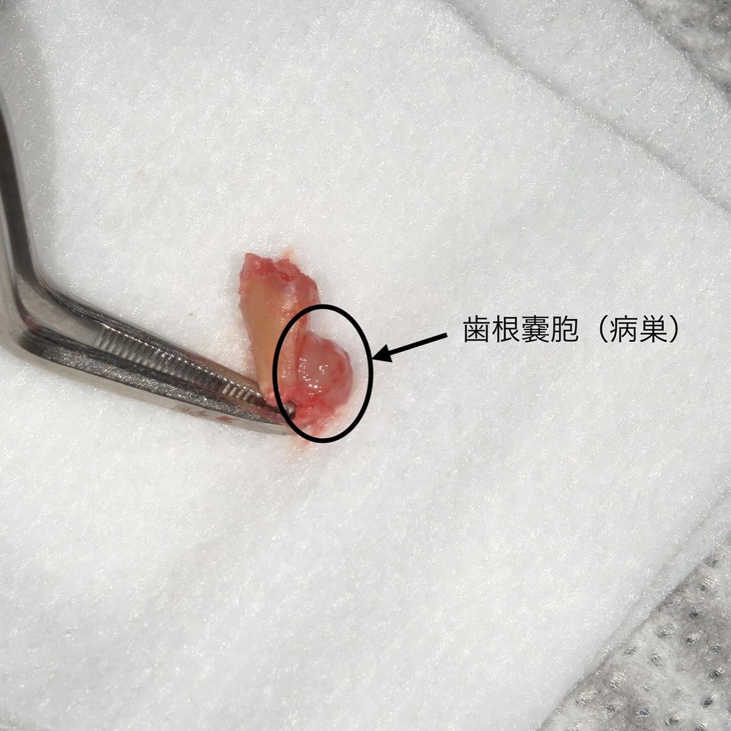 骨支持が不足している事により抜歯に至ったケースを紹介します🦷