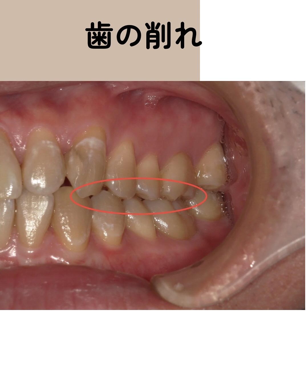 歯ぎしり・食いしばり していませんか？