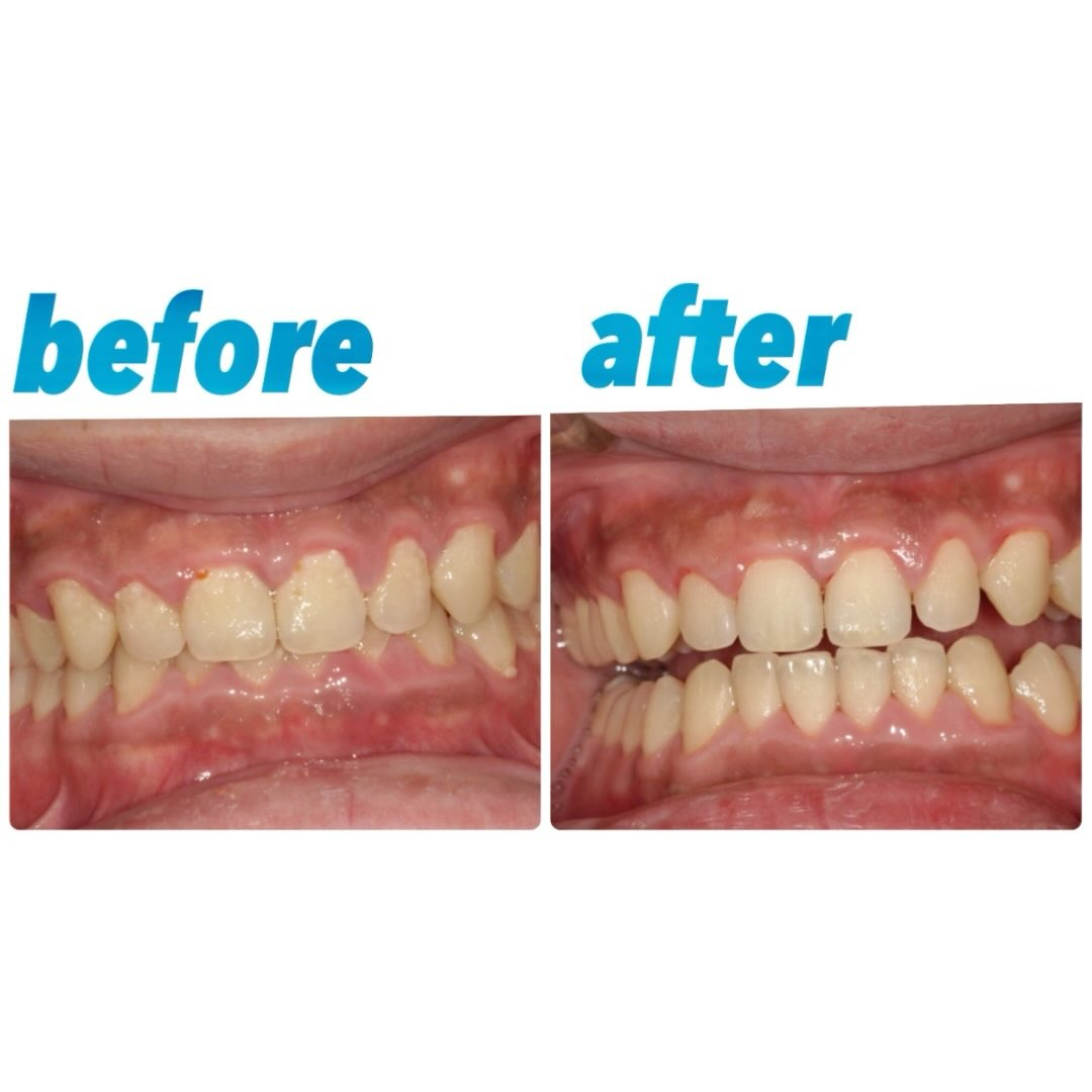 歯茎の腫れと歯表面のプラーク付着が強い方の症例写真です👀