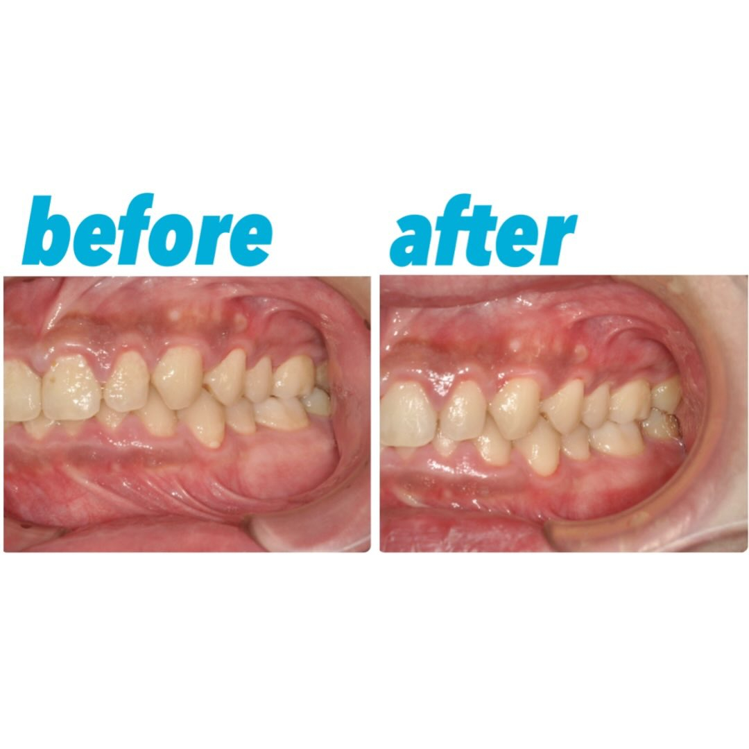 歯茎の腫れと歯表面のプラーク付着が強い方の症例写真です👀