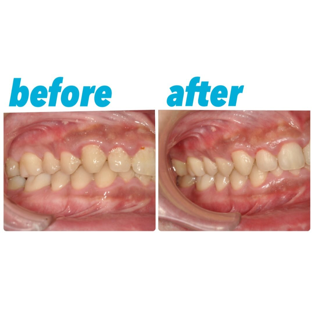 歯茎の腫れと歯表面のプラーク付着が強い方の症例写真です👀