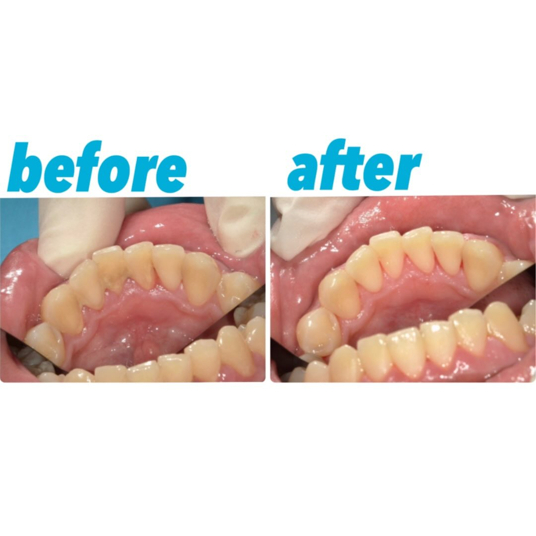 歯茎の腫れと歯表面のプラーク付着が強い方の症例写真です👀