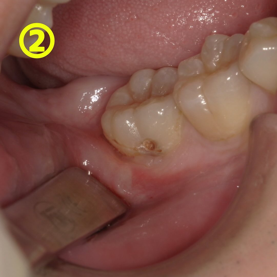 一見小さな虫歯でも、実は内部深くに進行している時があるんです...