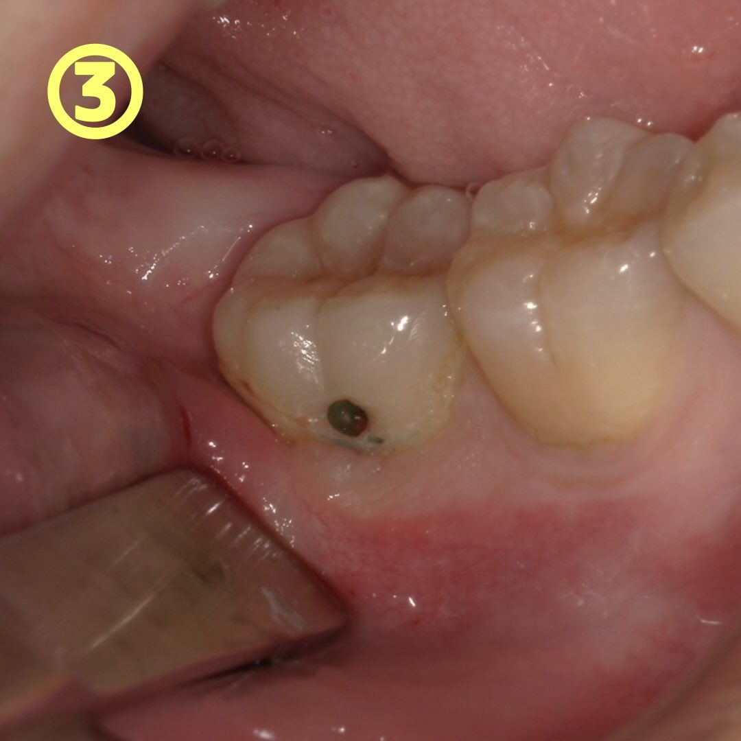 一見小さな虫歯でも、実は内部深くに進行している時があるんです...