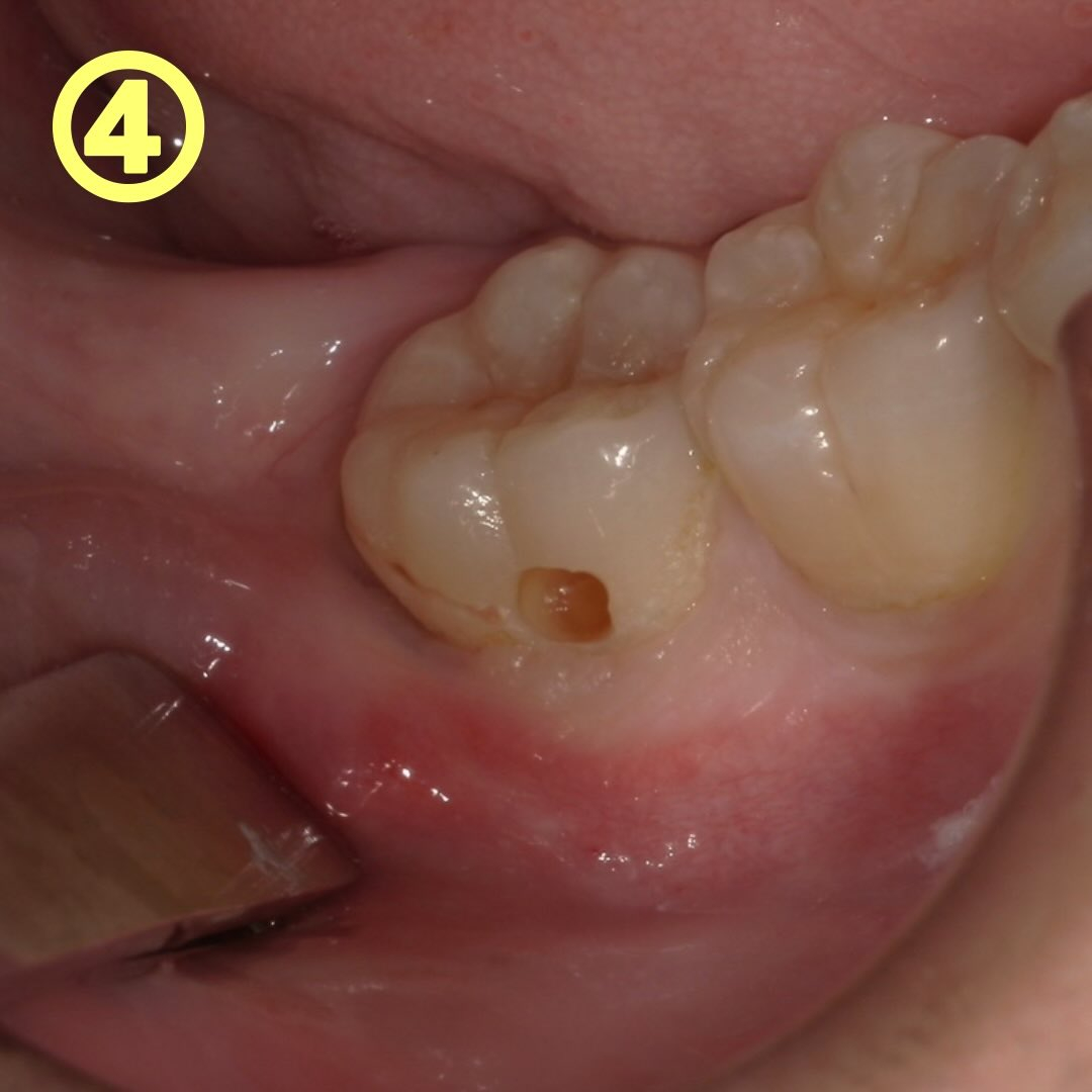一見小さな虫歯でも、実は内部深くに進行している時があるんです...