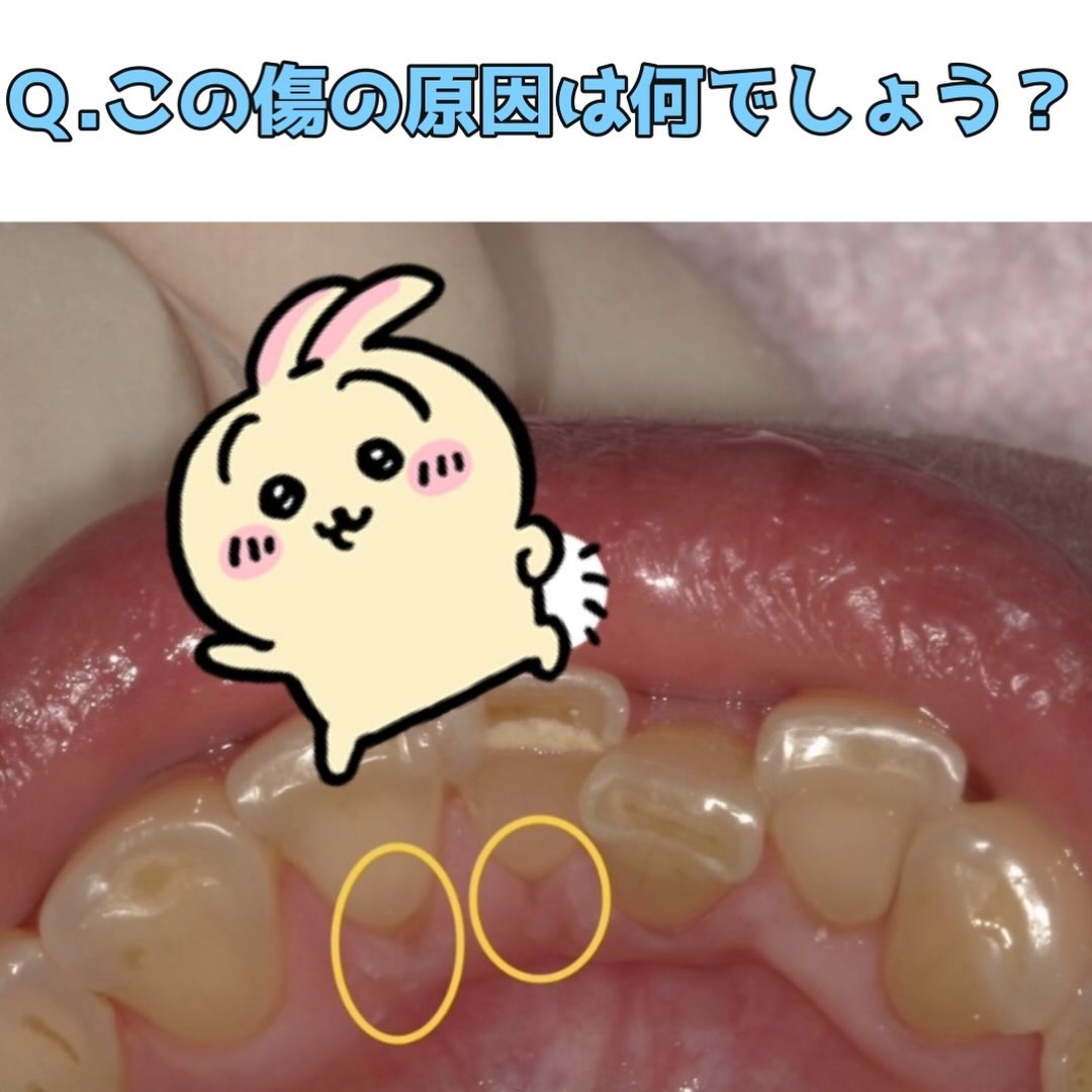 定期検診の際に汚れが目立っていたため当日に清掃指導と歯石取り...