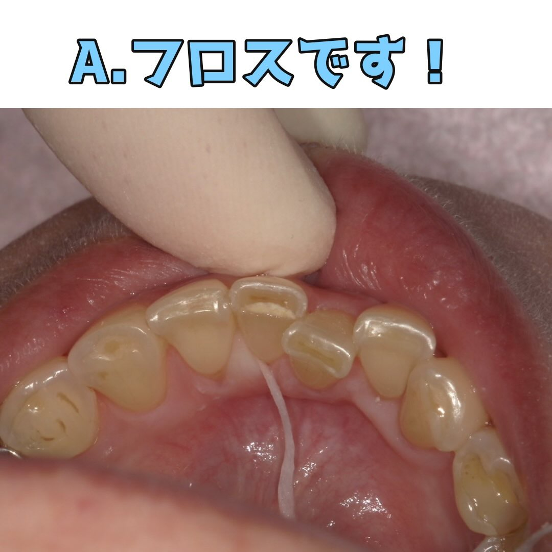 定期検診の際に汚れが目立っていたため当日に清掃指導と歯石取り...