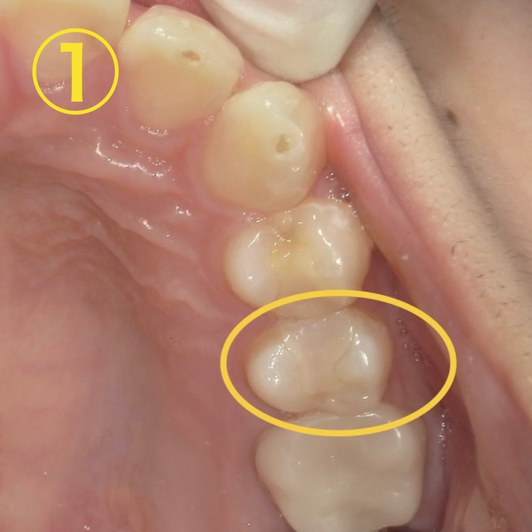 昔治療した所がたまに沁みるようになった、と当院を初診来院され...