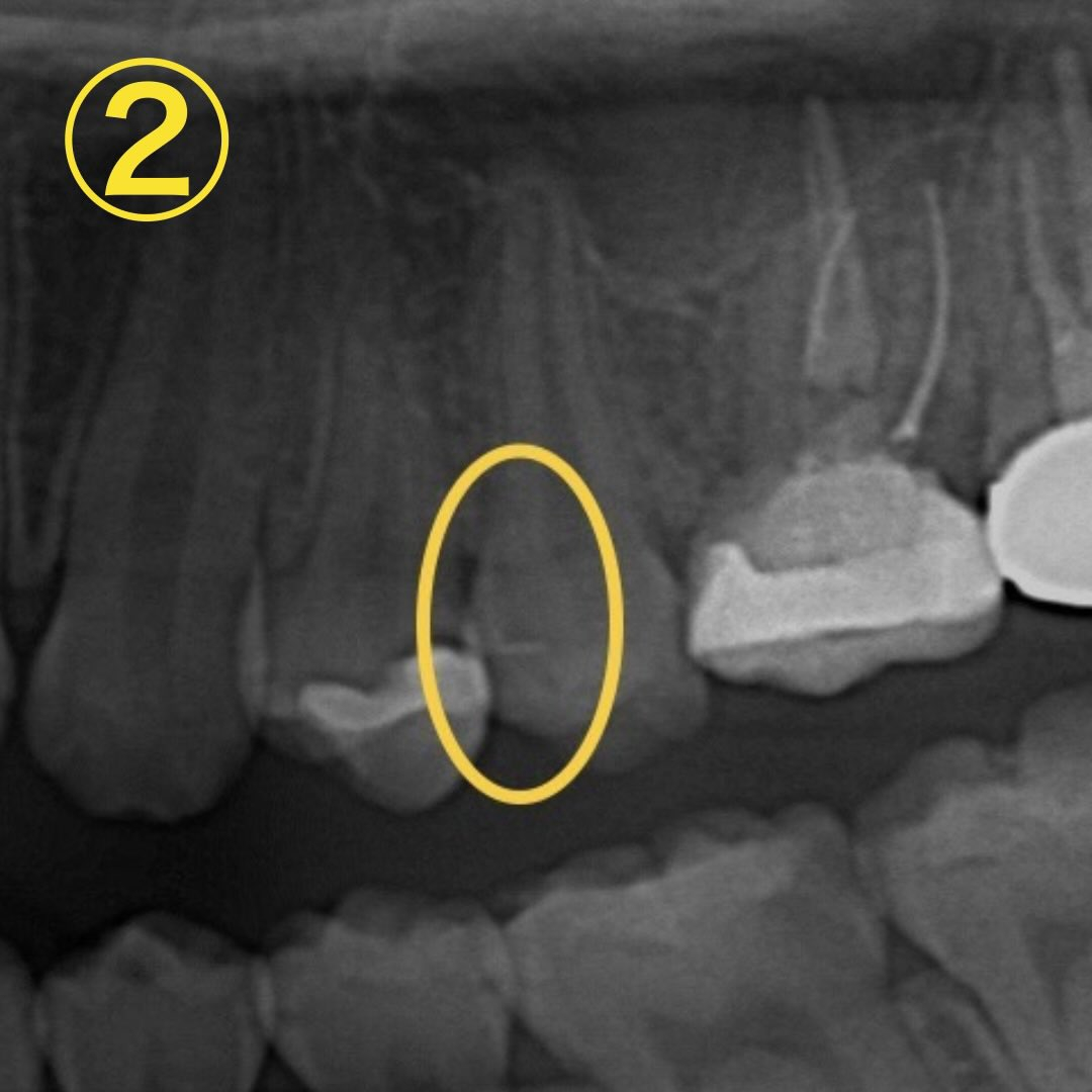 昔治療した所がたまに沁みるようになった、と当院を初診来院され...