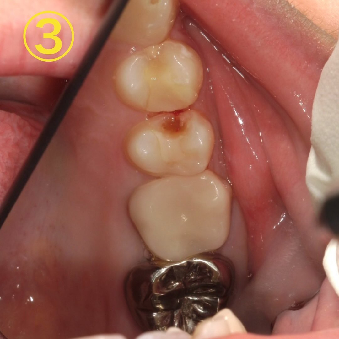 昔治療した所がたまに沁みるようになった、と当院を初診来院され...