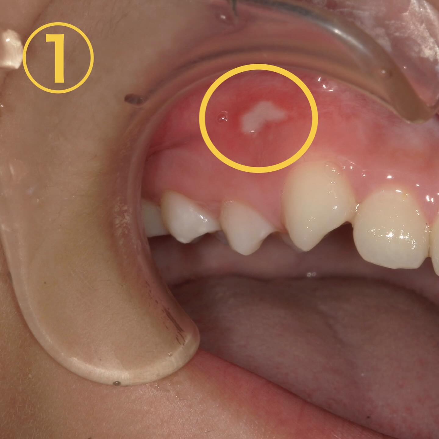 口内炎に似た所見🔍