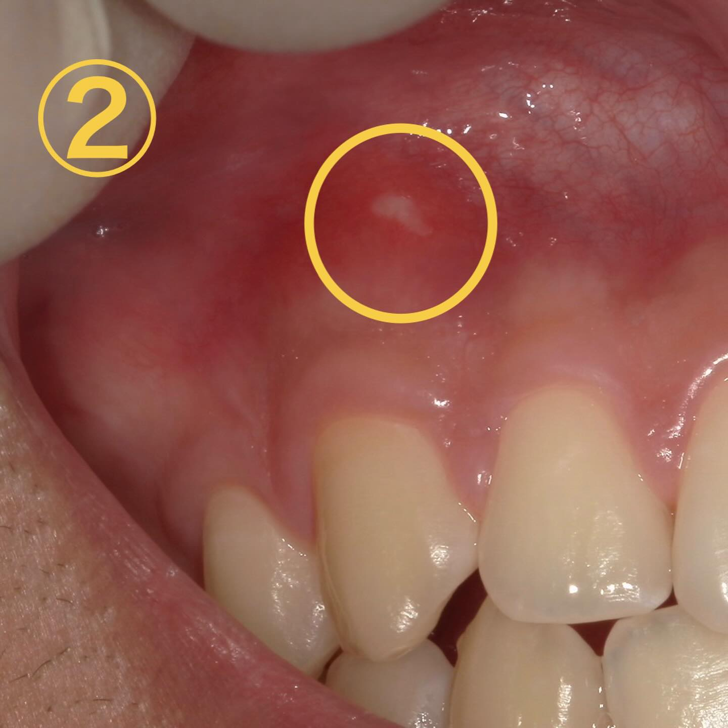 口内炎に似た所見🔍