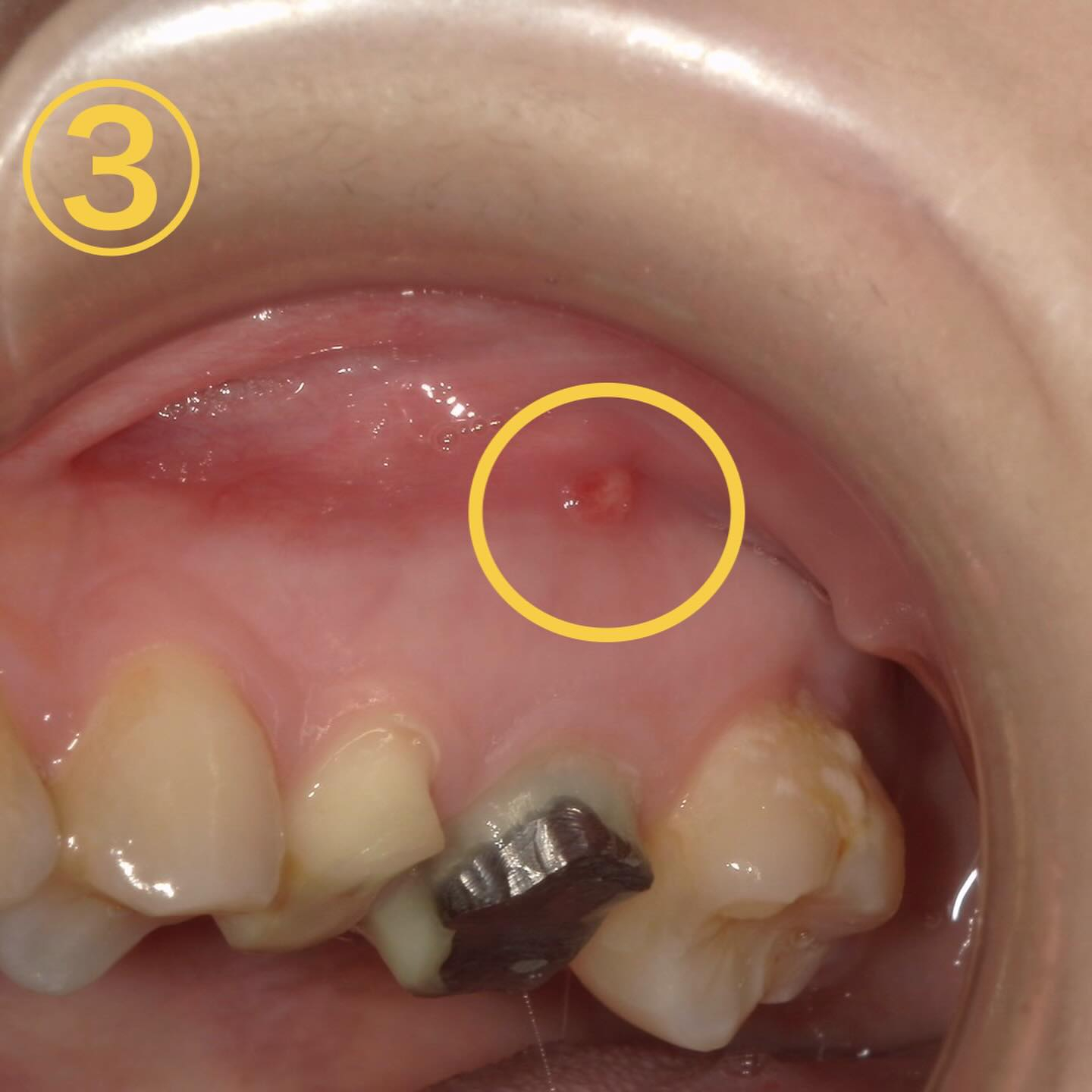 口内炎に似た所見🔍