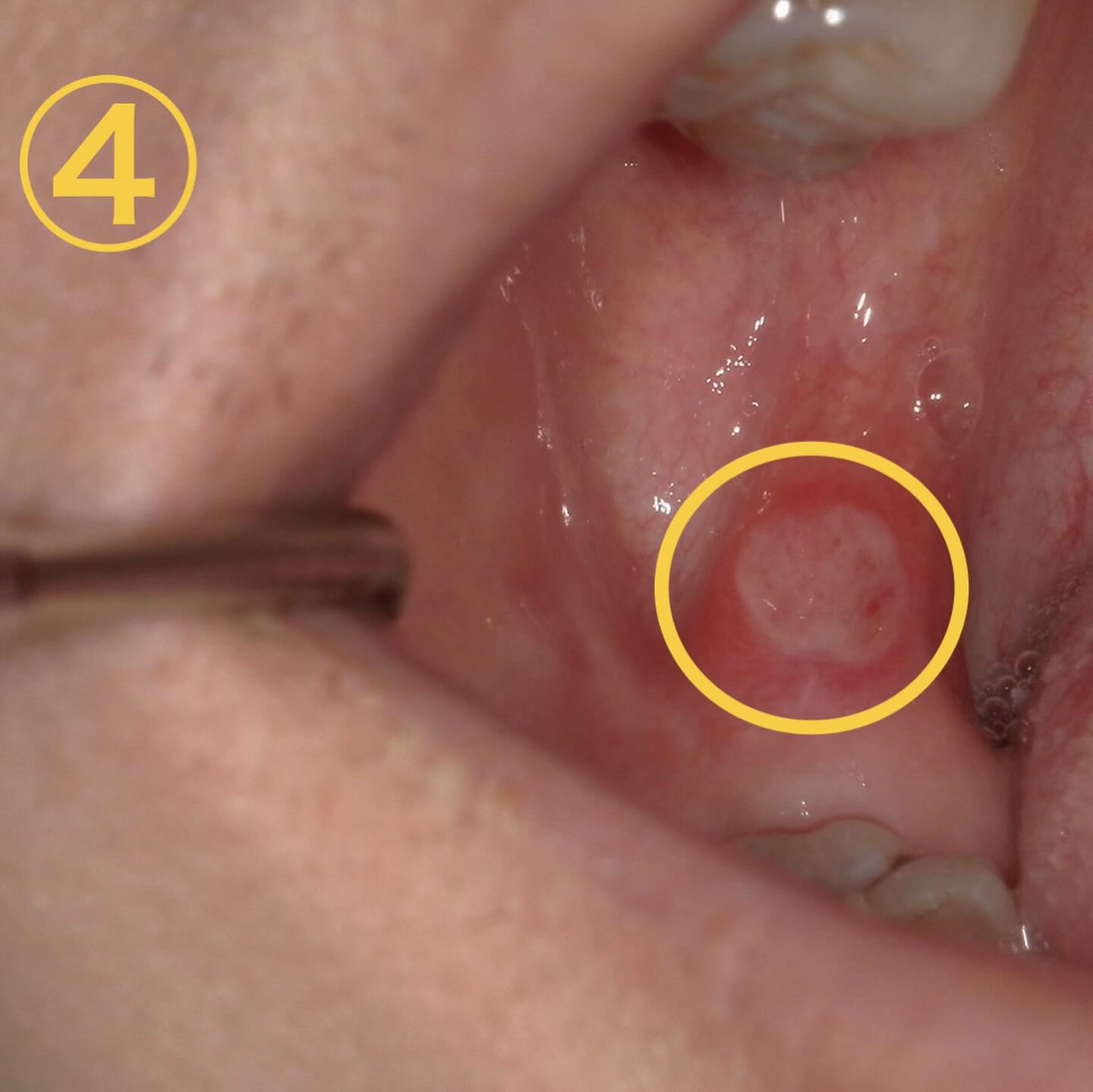口内炎に似た所見🔍
