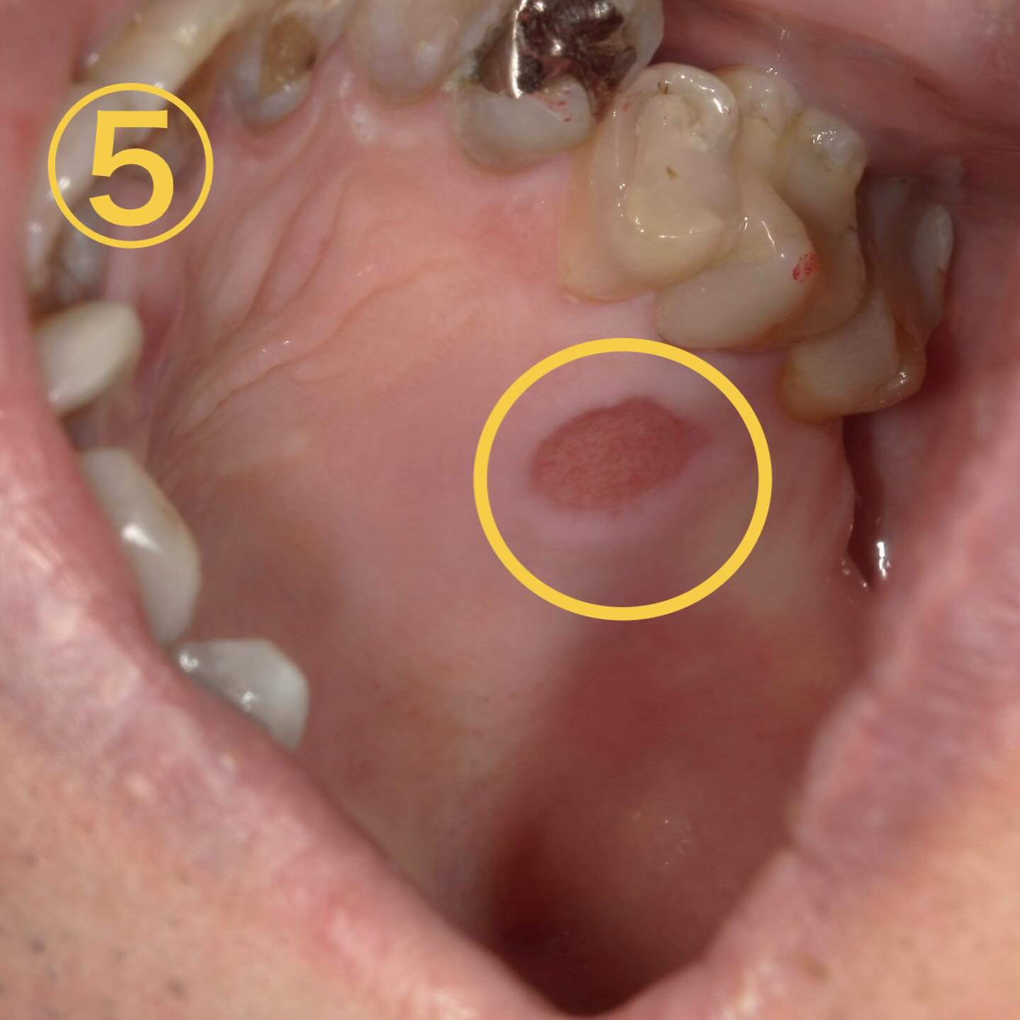口内炎に似た所見🔍
