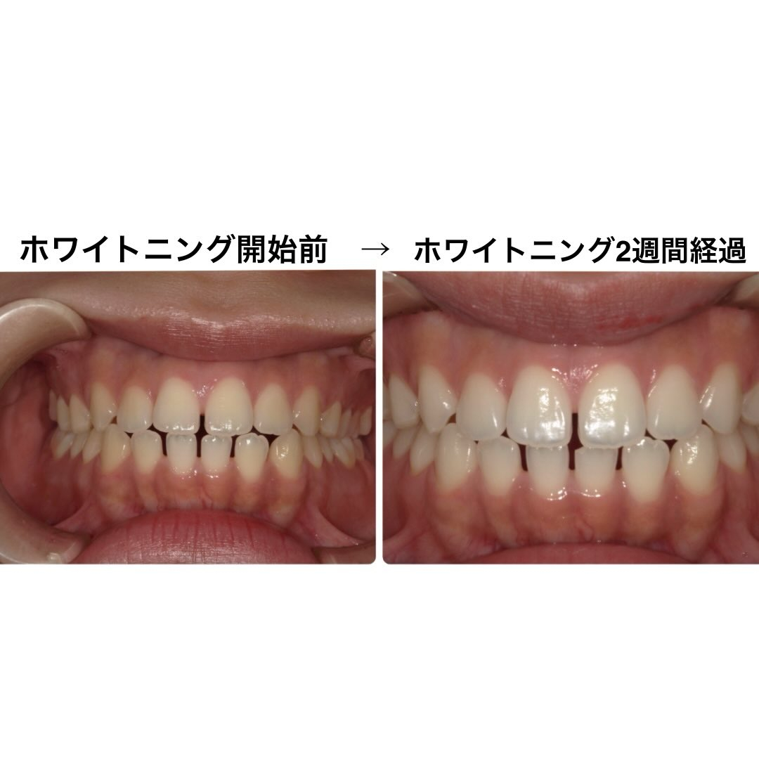 ホームホワイトニング開始後、2週間の経過写真です📸