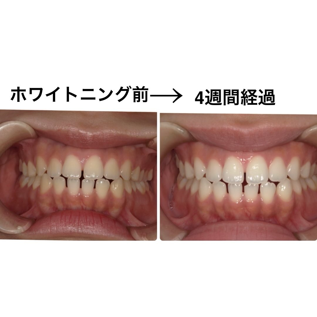 以前投稿したホームホワイトニング2週間経過写真の続きです📸