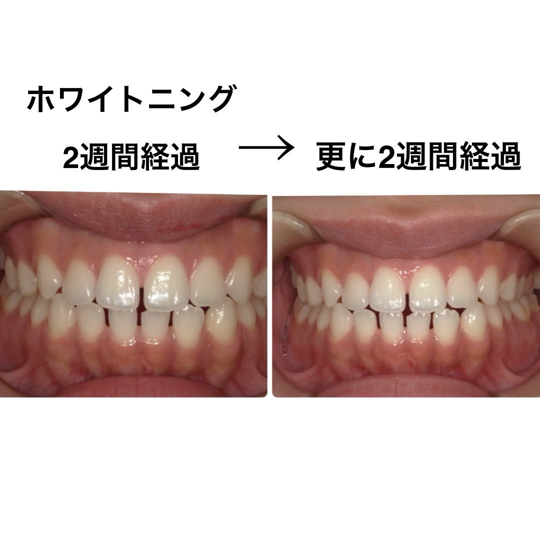 以前投稿したホームホワイトニング2週間経過写真の続きです📸