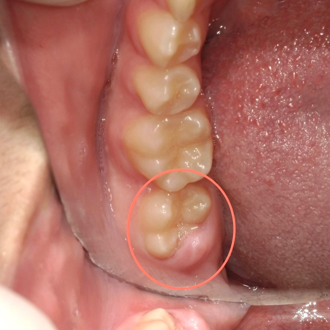 歯が生えてきてから物を噛むと痛い!と来院した患者さんの写真で...