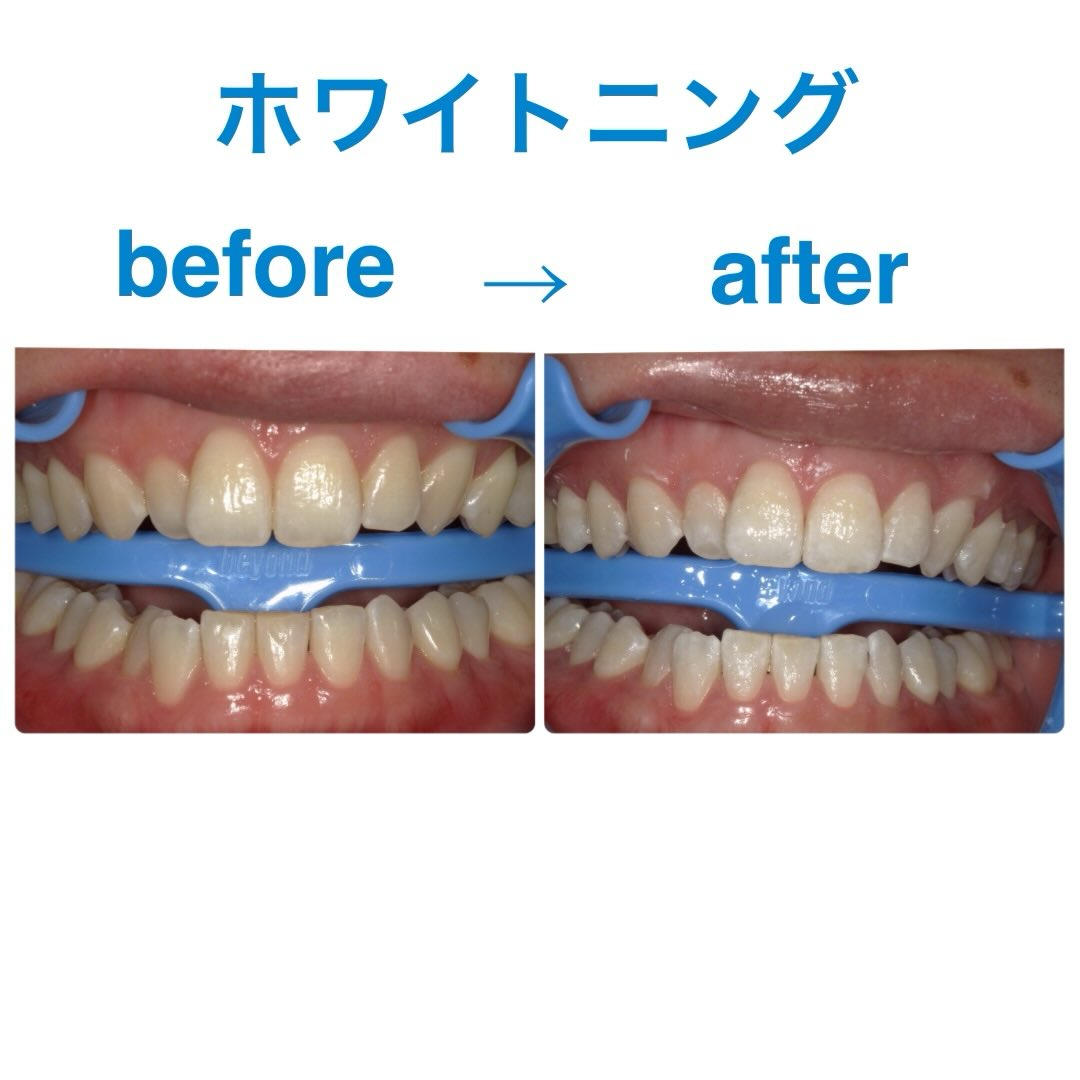 オフィスホワイトニング１回の効果です🧐