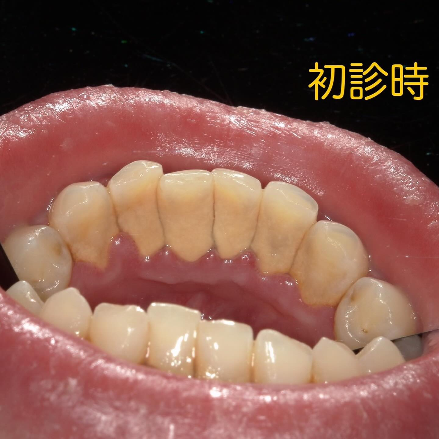 徹底的に歯石除去を行っても、定期検診の間隔があいてしまうと前...