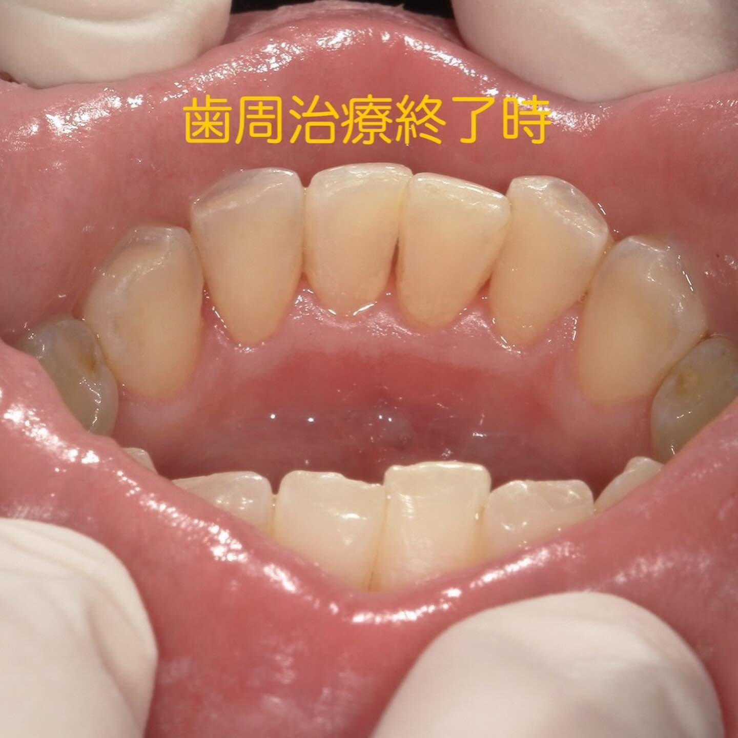 徹底的に歯石除去を行っても、定期検診の間隔があいてしまうと前...