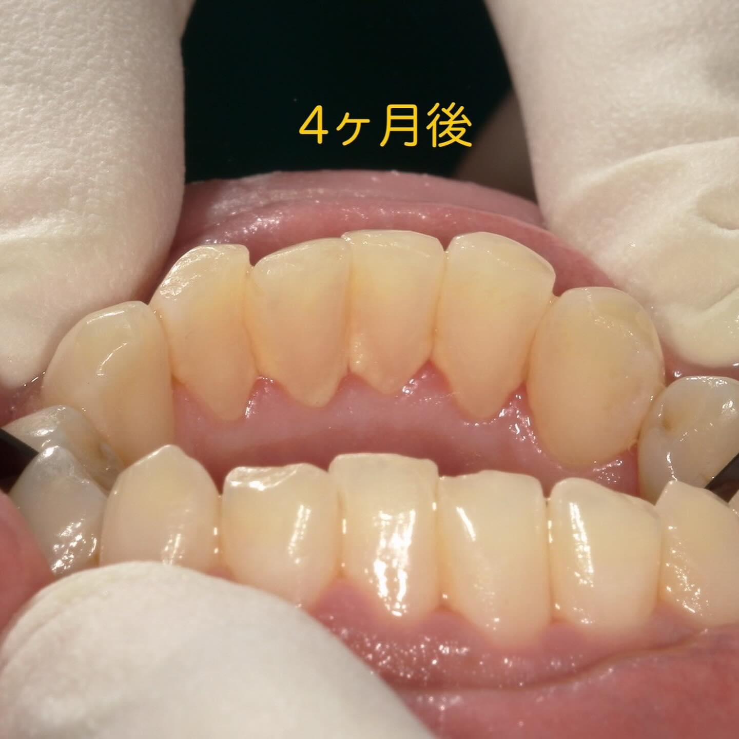 徹底的に歯石除去を行っても、定期検診の間隔があいてしまうと前...